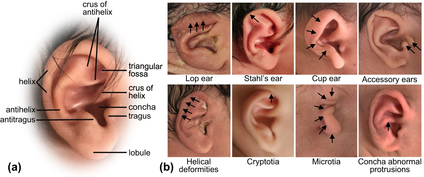 Ear malformations in babies
